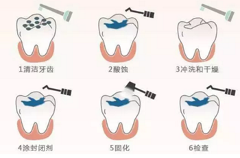 關于窩溝封閉