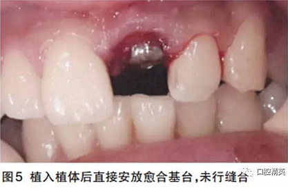 前牙即刻種植并個性化基臺美學修復