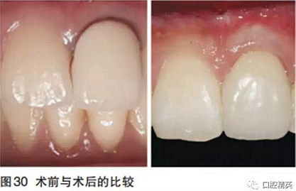 前牙即刻種植并個性化基臺美學修復