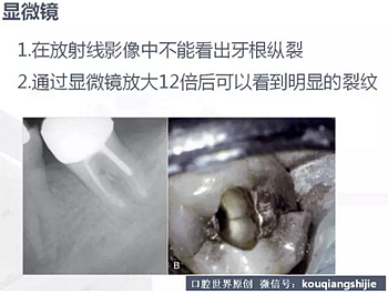 牙根縱裂