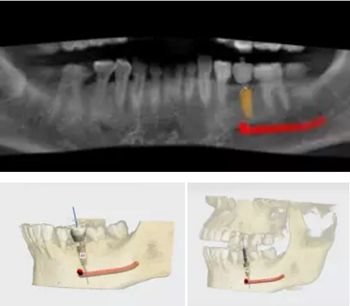 【病例分享】Implant Guide?數(shù)字化全程導(dǎo)航及椅旁即刻修復(fù)一例