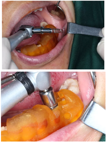 【病例分享】Implant Guide?數(shù)字化全程導(dǎo)航及椅旁即刻修復(fù)一例