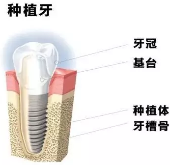 種植牙會(huì)松動(dòng)的原因是什么？