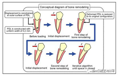 正畸文獻閱讀--對于滑動法關(guān)閉間隙的有限元分析