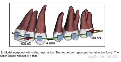 正畸文獻(xiàn)閱讀--對(duì)于滑動(dòng)法關(guān)閉間隙的有限元分析