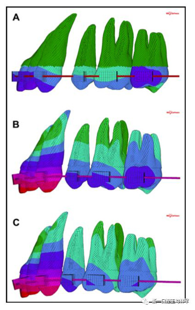 正畸文獻閱讀--對于滑動法關(guān)閉間隙的有限元分析