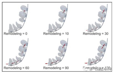 正畸文獻閱讀--對于滑動法關(guān)閉間隙的有限元分析