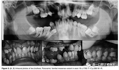 正畸文獻(xiàn)閱讀--原發(fā)性萌出失?。夯旌涎懒械呐R床和遺傳學(xué)研究