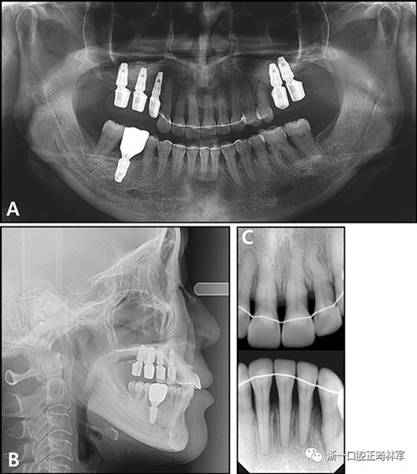 文獻優(yōu)秀正畸病例賞析--多顆牙齒缺失的牙周炎患者的跨學(xué)科綜合治療