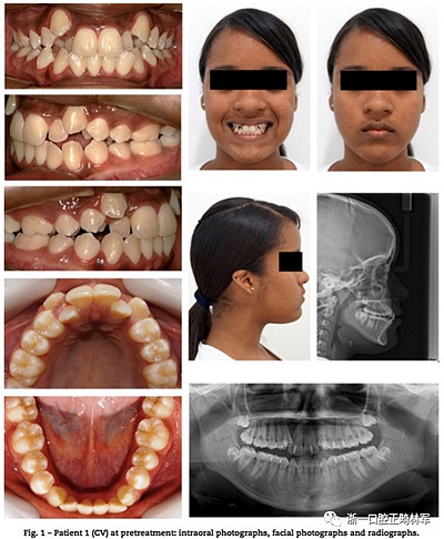 文獻(xiàn)優(yōu)秀正畸病例賞析--同卵雙胞胎使用自鎖托槽和傳統(tǒng)托槽正畸治療比較