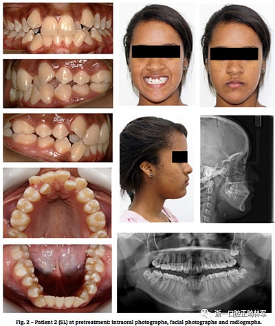 文獻(xiàn)優(yōu)秀正畸病例賞析--同卵雙胞胎使用自鎖托槽和傳統(tǒng)托槽正畸治療比較