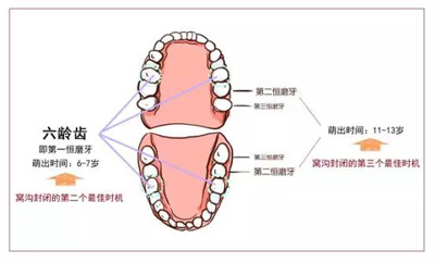 窩溝封閉丨孩子牙齒的“鎧甲勇士”