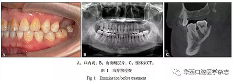 利用壓膜式活動(dòng)矯治器壓入下頜第一、第二磨牙1例