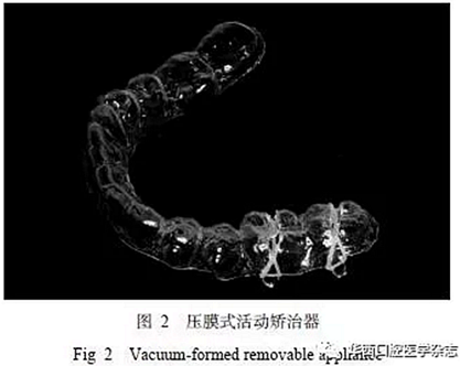 利用壓膜式活動(dòng)矯治器壓入下頜第一、第二磨牙1例