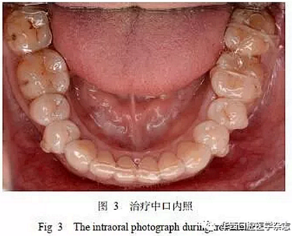 利用壓膜式活動(dòng)矯治器壓入下頜第一、第二磨牙1例