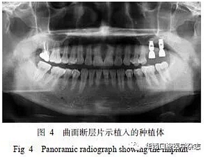 利用壓膜式活動(dòng)矯治器壓入下頜第一、第二磨牙1例