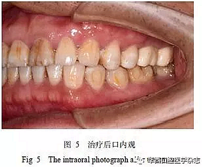 利用壓膜式活動(dòng)矯治器壓入下頜第一、第二磨牙1例