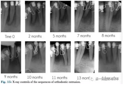 文獻(xiàn)優(yōu)秀正畸病例賞析--正畸牙周聯(lián)合治療方法病例介紹