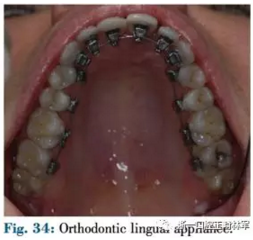 文獻(xiàn)優(yōu)秀正畸病例賞析--正畸牙周聯(lián)合治療方法病例介紹