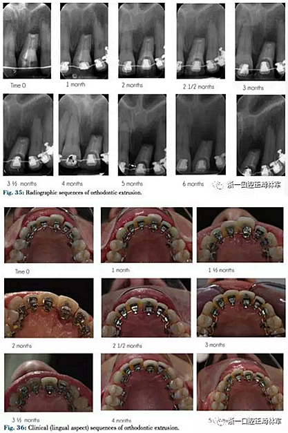 文獻(xiàn)優(yōu)秀正畸病例賞析--正畸牙周聯(lián)合治療方法病例介紹