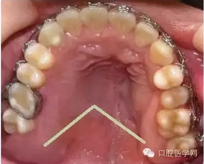 牙床骨質(zhì)突起的原因和處理措施