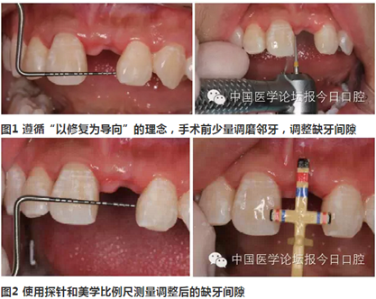 手把手教你做種植軟組織成形