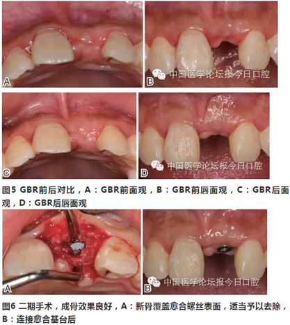 手把手教你做種植軟組織成形