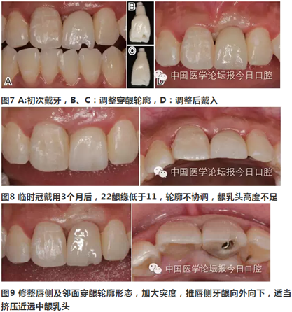 手把手教你做種植軟組織成形