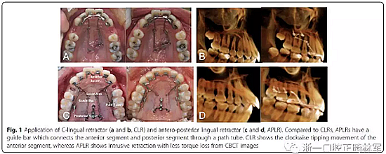 正畸文獻閱讀--用舌側滑動牽引系統(tǒng)控制前牙區(qū)段：初步的CBCT研究