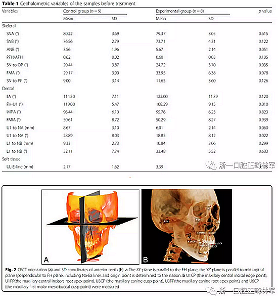 正畸文獻閱讀--用舌側滑動牽引系統(tǒng)控制前牙區(qū)段：初步的CBCT研究
