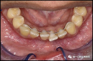 正畸文獻閱讀--固定舌側保持器作用下意外的牙齒移動