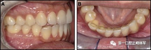 正畸文獻閱讀--固定舌側保持器作用下意外的牙齒移動