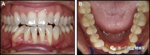 正畸文獻閱讀--固定舌側保持器作用下意外的牙齒移動