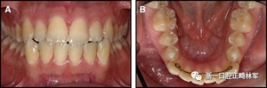 正畸文獻閱讀--固定舌側保持器作用下意外的牙齒移動