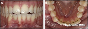 正畸文獻閱讀--固定舌側保持器作用下意外的牙齒移動