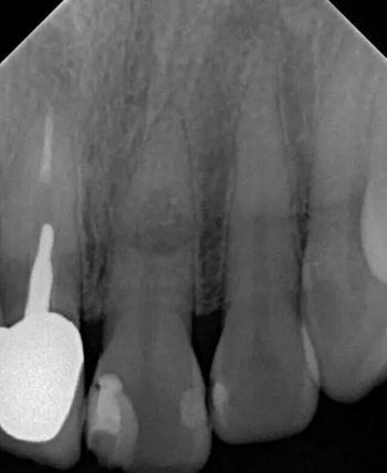 伴隨根管內(nèi)鈣化物形成牙根內(nèi)吸收治療1例