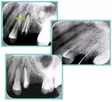 知識分享：根管治療的標(biāo)準(zhǔn)步驟
