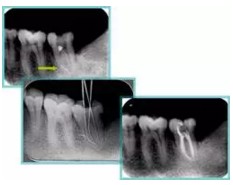 知識分享：根管治療的標(biāo)準(zhǔn)步驟