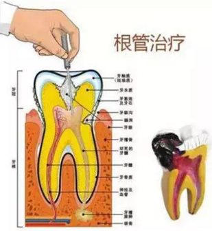 醫(yī)生，牙齒折斷不是應該補上去嗎，為啥要做根管治療？