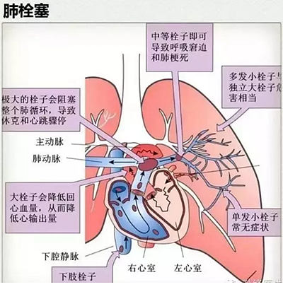 牙醫(yī)要注意！3％雙氧水口腔內(nèi)沖洗致氣體栓塞