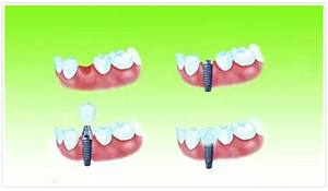 種植牙常見(jiàn)問(wèn)答你知道多少？