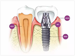 種植牙常見(jiàn)問(wèn)答你知道多少？