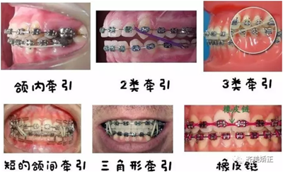 牙齒矯正，為什么要掛橡皮筋？