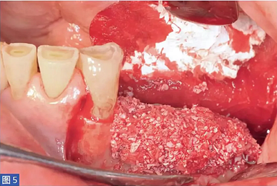 柵欄技術(shù)用于局部三維骨增量 —技術(shù)概述與病例匯報(bào) （1）