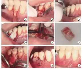 側(cè)向轉(zhuǎn)位瓣結(jié)合上皮下結(jié)締組織移植治療重度MillerⅢ°牙齦退縮1例