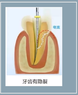 多頻技術(shù)的根管長度測定儀