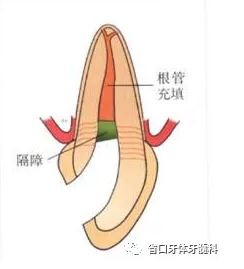 上前牙根管再治療后內(nèi)漂白1例