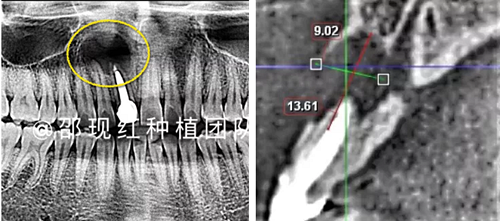 「科普篇」你真的了解它嗎？——β-磷酸三鈣