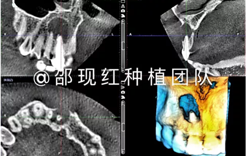 「科普篇」你真的了解它嗎？——β-磷酸三鈣