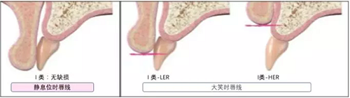 【文獻(xiàn)精讀】唇-齒-牙槽嵴分類：無(wú)牙頜上頜牙弓指南。診斷，風(fēng)險(xiǎn)評(píng)估及種植治療指征